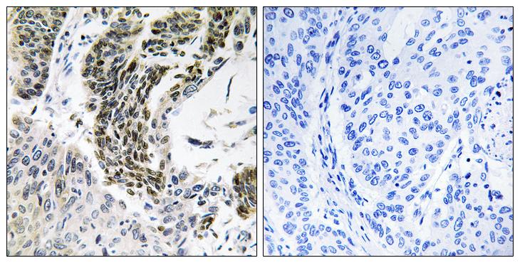 RREB1 Antibody - Peptide - + Immunohistochemistry analysis of paraffin-embedded human lung carcinoma tissue using RREB1 antibody.
