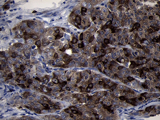 RRM2 Antibody - Immunohistochemical staining of paraffin-embedded Carcinoma of Human bladder tissue using anti-RRM2 mouse monoclonal antibody. (Heat-induced epitope retrieval by 1mM EDTA in 10mM Tris buffer. (pH8.5) at 120°C for 3 min. (1:2000)