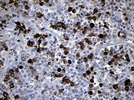 RRM2 Antibody - Immunohistochemical staining of paraffin-embedded Human lymphoma tissue using anti-RRM2 mouse monoclonal antibody. (Heat-induced epitope retrieval by 1mM EDTA in 10mM Tris buffer. (pH8.5) at 120°C for 3 min. (1:2000)