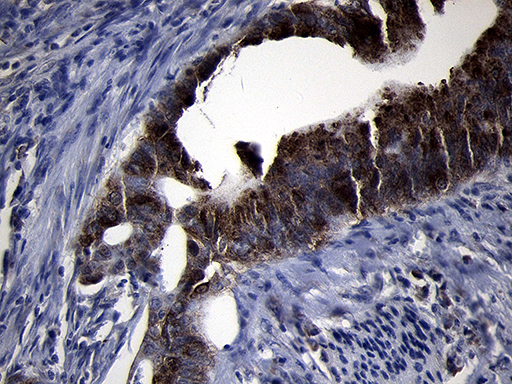 RRM2 Antibody - Immunohistochemical staining of paraffin-embedded Adenocarcinoma of Human colon tissue using anti-RRM2 mouse monoclonal antibody. (Heat-induced epitope retrieval by 1mM EDTA in 10mM Tris buffer. (pH8.5) at 120°C for 3 min. (1:2000)