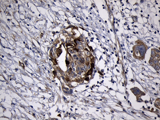 RRM2 Antibody - Immunohistochemical staining of paraffin-embedded Adenocarcinoma of Human ovary tissue using anti-RRM2 mouse monoclonal antibody. (Heat-induced epitope retrieval by 1mM EDTA in 10mM Tris buffer. (pH8.5) at 120°C for 3 min. (1:150)