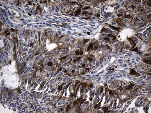 RRM2 Antibody - Immunohistochemical staining of paraffin-embedded Adenocarcinoma of Human endometrium tissue using anti-RRM2 mouse monoclonal antibody. (Heat-induced epitope retrieval by 1mM EDTA in 10mM Tris buffer. (pH8.5) at 120°C for 3 min. (1:150)