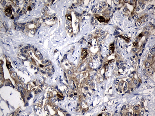 RRM2 Antibody - Immunohistochemical staining of paraffin-embedded Carcinoma of Human liver tissue using anti-RRM2 mouse monoclonal antibody. (Heat-induced epitope retrieval by 1mM EDTA in 10mM Tris buffer. (pH8.5) at 120°C for 3 min. (1:150)