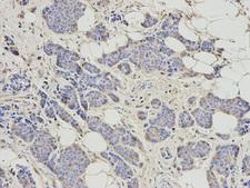 RRM2 Antibody - Immunohistochemistry of paraffin-embedded human breast cancer using RRM2 antibody at dilution of 1:200 (200x lens).
