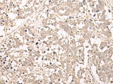 RRP1 Antibody - Immunohistochemistry of paraffin-embedded Human lung cancer tissue  using RRP1 Polyclonal Antibody at dilution of 1:45(×200)