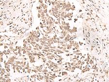 RRP1 Antibody - Immunohistochemistry of paraffin-embedded Human lung cancer tissue  using RRP1 Polyclonal Antibody at dilution of 1:40(×200)