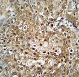 RRP36 Antibody - CF153 antibody immunohistochemistry of formalin-fixed and paraffin-embedded human cervix carcinoma followed by peroxidase-conjugated secondary antibody and DAB staining.