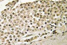 RRP8 Antibody - IHC of Cerebral 1 (L310) pAb in paraffin-embedded human breast carcinoma tissue.