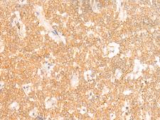 RRP8 Antibody - Immunohistochemistry of paraffin-embedded Human ovarian cancer tissue  using RRP8 Polyclonal Antibody at dilution of 1:50(×200)