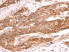 RRP8 Antibody - Immunohistochemistry of paraffin-embedded Human esophagus cancer tissue  using RRP8 Polyclonal Antibody at dilution of 1:80(×200)