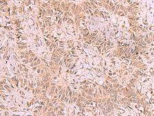 RRP8 Antibody - Immunohistochemistry of paraffin-embedded Human ovarian cancer tissue  using RRP8 Polyclonal Antibody at dilution of 1:70(×200)