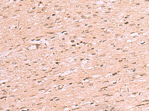 RRP8 Antibody - Immunohistochemistry of paraffin-embedded Human colorectal cancer tissue  using RRP8 Polyclonal Antibody at dilution of 1:70(×200)