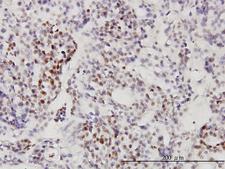 RRP9 Antibody - Immunoperoxidase of monoclonal antibody to RNU3IP2 on formalin-fixed paraffin-embedded human ovary, clear cell carcinoma. [antibody concentration 3 ug/ml].