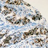 RRS1 Antibody - Immunohistochemical analysis of RRS1 staining in human colon cancer formalin fixed paraffin embedded tissue section. The section was pre-treated using heat mediated antigen retrieval with sodium citrate buffer (pH 6.0). The section was then incubated with the antibody at room temperature and detected with HRP and DAB as chromogen. The section was then counterstained with hematoxylin and mounted with DPX.