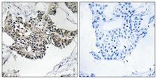 RSAD1 Antibody - Immunohistochemistry analysis of paraffin-embedded human breast carcinoma tissue, using RSAD1 Antibody. The picture on the right is blocked with the synthesized peptide.