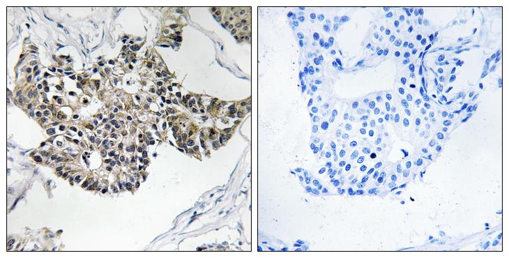 RSAD1 Antibody - Peptide - + Immunohistochemistry analysis of paraffin-embedded human breast carcinoma tissue, using RSAD1 antibody.