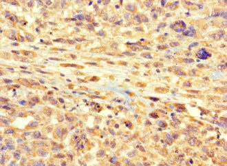 RSPH9 / C6orf206 Antibody - Immunohistochemistry of paraffin-embedded human melanoma cancer at dilution 1:100