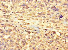 RSPH9 / C6orf206 Antibody - Immunohistochemistry of paraffin-embedded human melanoma cancer at dilution 1:100
