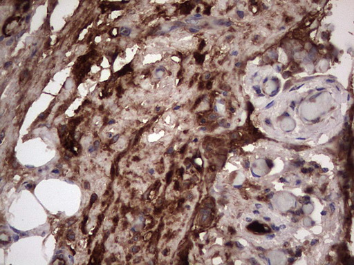 RSPO3 Antibody - Immunohistochemical staining of paraffin-embedded Adenocarcinoma of Human ovary tissue using anti-RSPO3 mouse monoclonal antibody. (Heat-induced epitope retrieval by 1 mM EDTA in 10mM Tris, pH8.5, 120C for 3min,