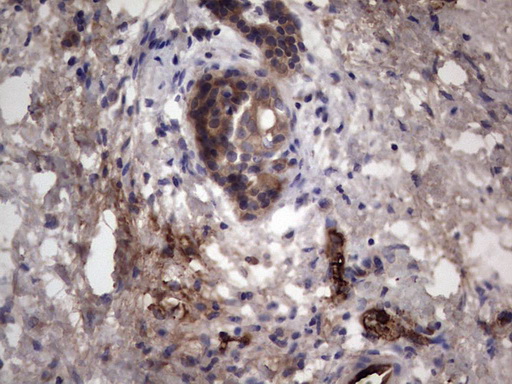 RSPO3 Antibody - Immunohistochemical staining of paraffin-embedded Carcinoma of Human pancreas tissue using anti-RSPO3 mouse monoclonal antibody. (Heat-induced epitope retrieval by 1 mM EDTA in 10mM Tris, pH8.5, 120C for 3min,