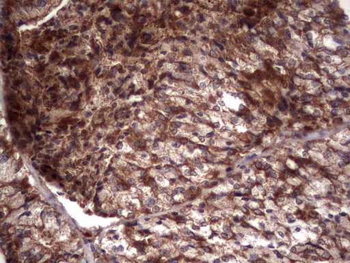 RSPO3 Antibody - Immunohistochemical staining of paraffin-embedded Carcinoma of Human thyroid tissue using anti-RSPO3 mouse monoclonal antibody. (Heat-induced epitope retrieval by 1 mM EDTA in 10mM Tris, pH8.5, 120C for 3min,
