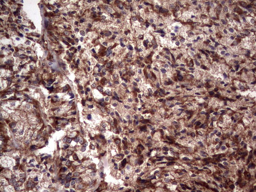 RSPO3 Antibody - Immunohistochemical staining of paraffin-embedded Human endometrium tissue within the normal limits using anti-RSPO3 mouse monoclonal antibody. (Heat-induced epitope retrieval by 1 mM EDTA in 10mM Tris, pH8.5, 120C for 3min,