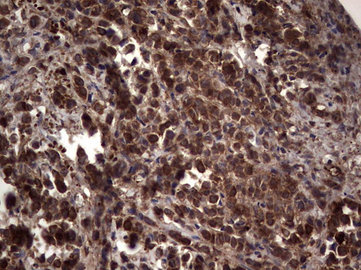 RSPO3 Antibody - Immunohistochemical staining of paraffin-embedded Adenocarcinoma of Human breast tissue using anti-RSPO3 mouse monoclonal antibody. (Heat-induced epitope retrieval by 1 mM EDTA in 10mM Tris, pH8.5, 120C for 3min,