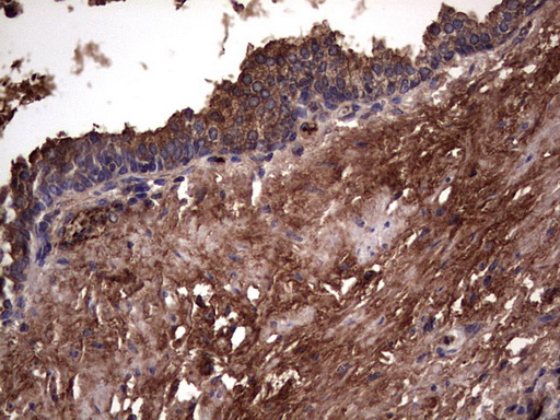 RSPO3 Antibody - Immunohistochemical staining of paraffin-embedded Carcinoma of Human prostate tissue using anti-RSPO3 mouse monoclonal antibody. (Heat-induced epitope retrieval by 1 mM EDTA in 10mM Tris, pH8.5, 120C for 3min,