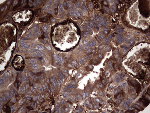 RSPO3 Antibody - Immunohistochemical staining of paraffin-embedded Adenocarcinoma of Human colon tissue using anti-RSPO3 mouse monoclonal antibody. (Heat-induced epitope retrieval by 1 mM EDTA in 10mM Tris, pH8.5, 120C for 3min,