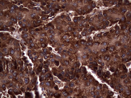 RSPO3 Antibody - Immunohistochemical staining of paraffin-embedded Carcinoma of Human liver tissue using anti-RSPO3 mouse monoclonal antibody. (Heat-induced epitope retrieval by 1 mM EDTA in 10mM Tris, pH8.5, 120C for 3min,