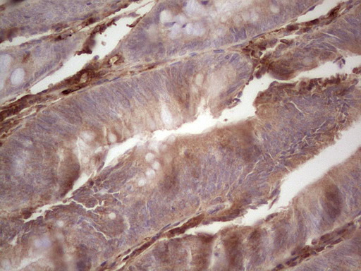 RSPO3 Antibody - Immunohistochemical staining of paraffin-embedded Adenocarcinoma of Human colon tissue using anti-RSPO3 mouse monoclonal antibody.  heat-induced epitope retrieval by 1 mM EDTA in 10mM Tris, pH8.5, 120C for 3min)
