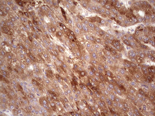 RSPO3 Antibody - Immunohistochemical staining of paraffin-embedded Carcinoma of Human liver tissue using anti-RSPO3 mouse monoclonal antibody.  heat-induced epitope retrieval by 1 mM EDTA in 10mM Tris, pH8.5, 120C for 3min)