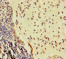 RSPO3 Antibody - Immunohistochemistry of paraffin-embedded human lung cancer using RSPO3 Antibody at dilution of 1:100