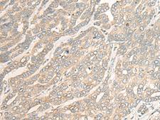 RSU1 Antibody - Immunohistochemistry of paraffin-embedded Human liver cancer tissue  using RSU1 Polyclonal Antibody at dilution of 1:30(×200)