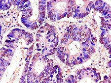 RTCB / C22orf28 Antibody - Immunohistochemistry of paraffin-embedded human colon cancer using RTCB Antibody at dilution of 1:100