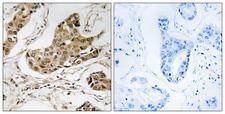 RTCD1 / RPC Antibody - Immunohistochemistry analysis of paraffin-embedded human breast carcinoma tissue, using RTCD1 Antibody. The picture on the right is blocked with the synthesized peptide.