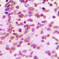 RTCD1 / RPC Antibody - Immunohistochemical analysis of RPC staining in human breast cancer formalin fixed paraffin embedded tissue section. The section was pre-treated using heat mediated antigen retrieval with sodium citrate buffer (pH 6.0). The section was then incubated with the antibody at room temperature and detected using an HRP conjugated compact polymer system. DAB was used as the chromogen. The section was then counterstained with hematoxylin and mounted with DPX.