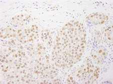 RTF1 Antibody - Detection of Human Rtf1 by Immunohistochemistry. Sample: FFPE section of human breast carcinoma. Antibody: Affinity purified rabbit anti-Rtf1 used at a dilution of 1:250.