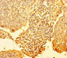RTF1 Antibody - Immunohistochemistry of paraffin-embedded human cervical cancer at dilution 1:100