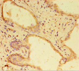 RTF1 Antibody - Immunohistochemistry of paraffin-embedded human prostate cancer at dilution 1:100