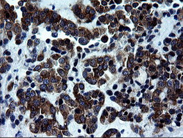 RTKN / Rhotekin Antibody - IHC of paraffin-embedded Adenocarcinoma of Human ovary tissue using anti-RTKN mouse monoclonal antibody. (Heat-induced epitope retrieval by 10mM citric buffer, pH6.0, 100C for 10min).