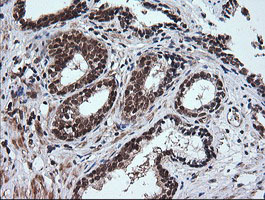 RTKN / Rhotekin Antibody - IHC of paraffin-embedded Carcinoma of Human prostate tissue using anti-RTKN mouse monoclonal antibody.