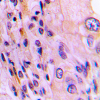 RTKN / Rhotekin Antibody - Immunohistochemical analysis of Rhotekin staining in human lung cancer formalin fixed paraffin embedded tissue section. The section was pre-treated using heat mediated antigen retrieval with sodium citrate buffer (pH 6.0). The section was then incubated with the antibody at room temperature and detected using an HRP-conjugated compact polymer system. DAB was used as the chromogen. The section was then counterstained with hematoxylin and mounted with DPX.