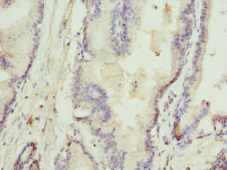 RTKN / Rhotekin Antibody - Immunohistochemistry of paraffin-embedded human prostata cancer at dilution 1:100