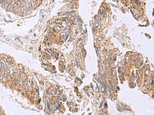 RTKN2 Antibody - Immunohistochemistry of paraffin-embedded Human colorectal cancer tissue  using RTKN2 Polyclonal Antibody at dilution of 1:75(×200)