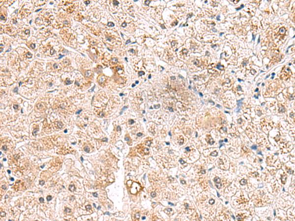 RTKN2 Antibody - Immunohistochemistry of paraffin-embedded Human liver cancer tissue  using RTKN2 Polyclonal Antibody at dilution of 1:75(×200)