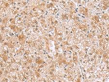 RTKN2 Antibody - Immunohistochemistry of paraffin-embedded Human liver cancer tissue  using RTKN2 Polyclonal Antibody at dilution of 1:70(×200)