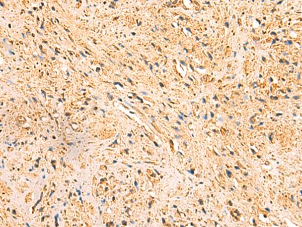 RTN1 / Reticulon 1 Antibody - Immunohistochemistry of paraffin-embedded Human prost at e cancer tissue  using RTN1 Polyclonal Antibody at dilution of 1:50(×200)