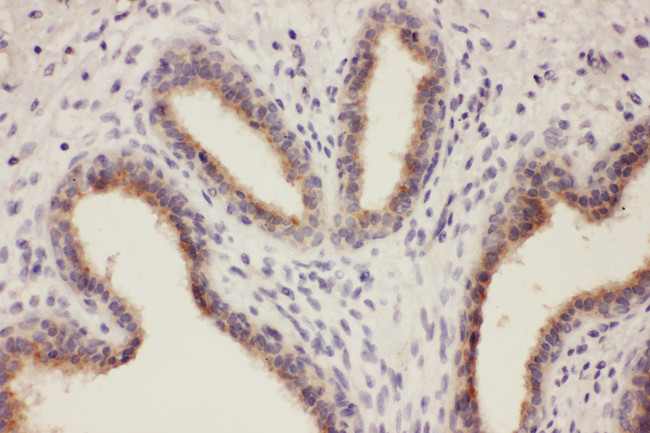 RTN3 / Reticulon 3 Antibody - RTN3 / Reticulon 3 antibody. IHC(P): Human Breast Cancer Tissue.