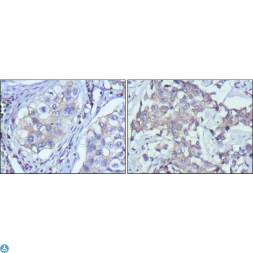 RTN3 / Reticulon 3 Antibody - Immunohistochemistry (IHC) analysis of paraffin-embedded human lung cancer (left) and breast cancer (right) with DAB staining using Rtn-3 Monoclonal Antibody.